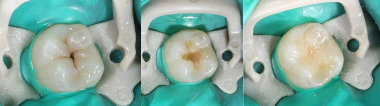 Результат лечения: до и после