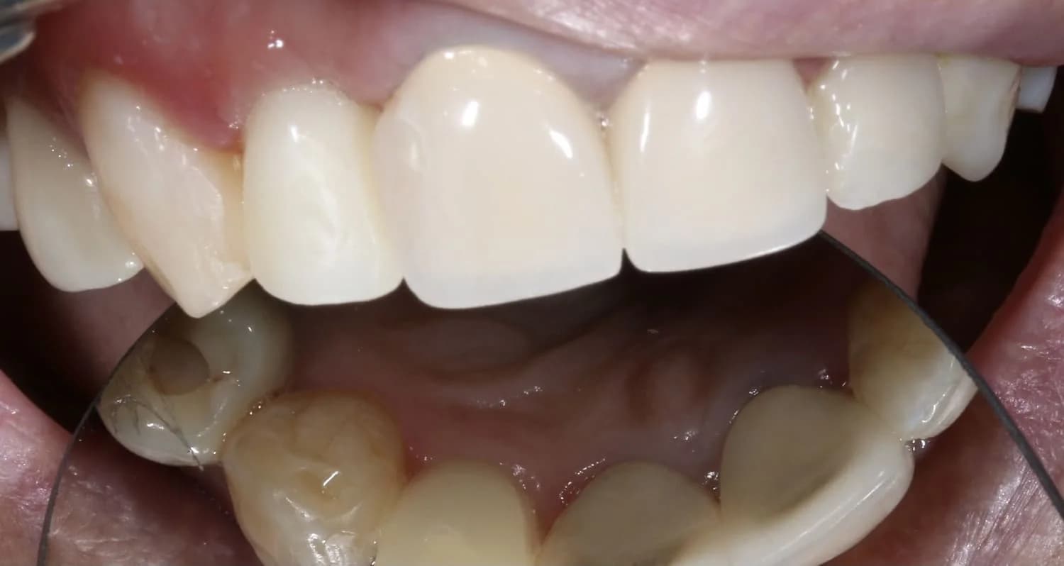 Дентальная имплантация в фронтальном отделе с пластикой десны