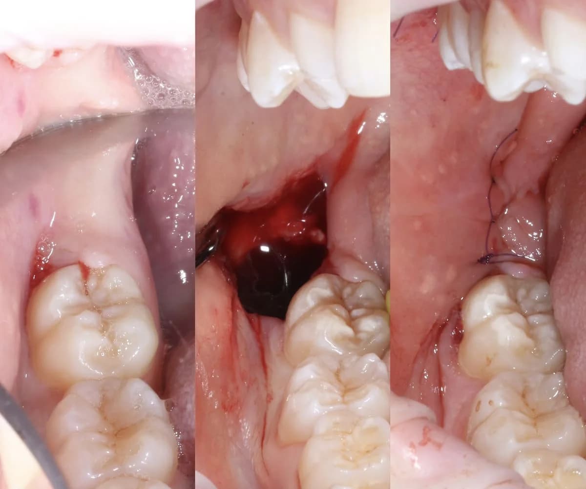 Удаление зачатка зуба мудрости (14 лет)