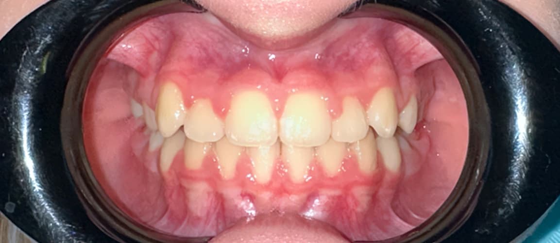 Частичные брекеты: ещё один клинический случай