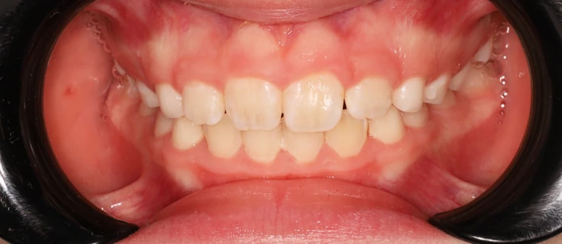 Ортодонтия в два этапа: пластинка и брекеты