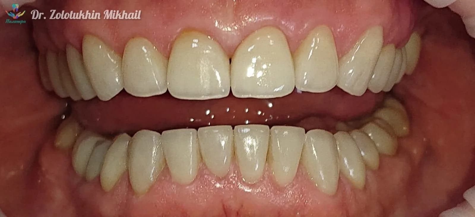 Керамические виниры и тотальная реабилитация
