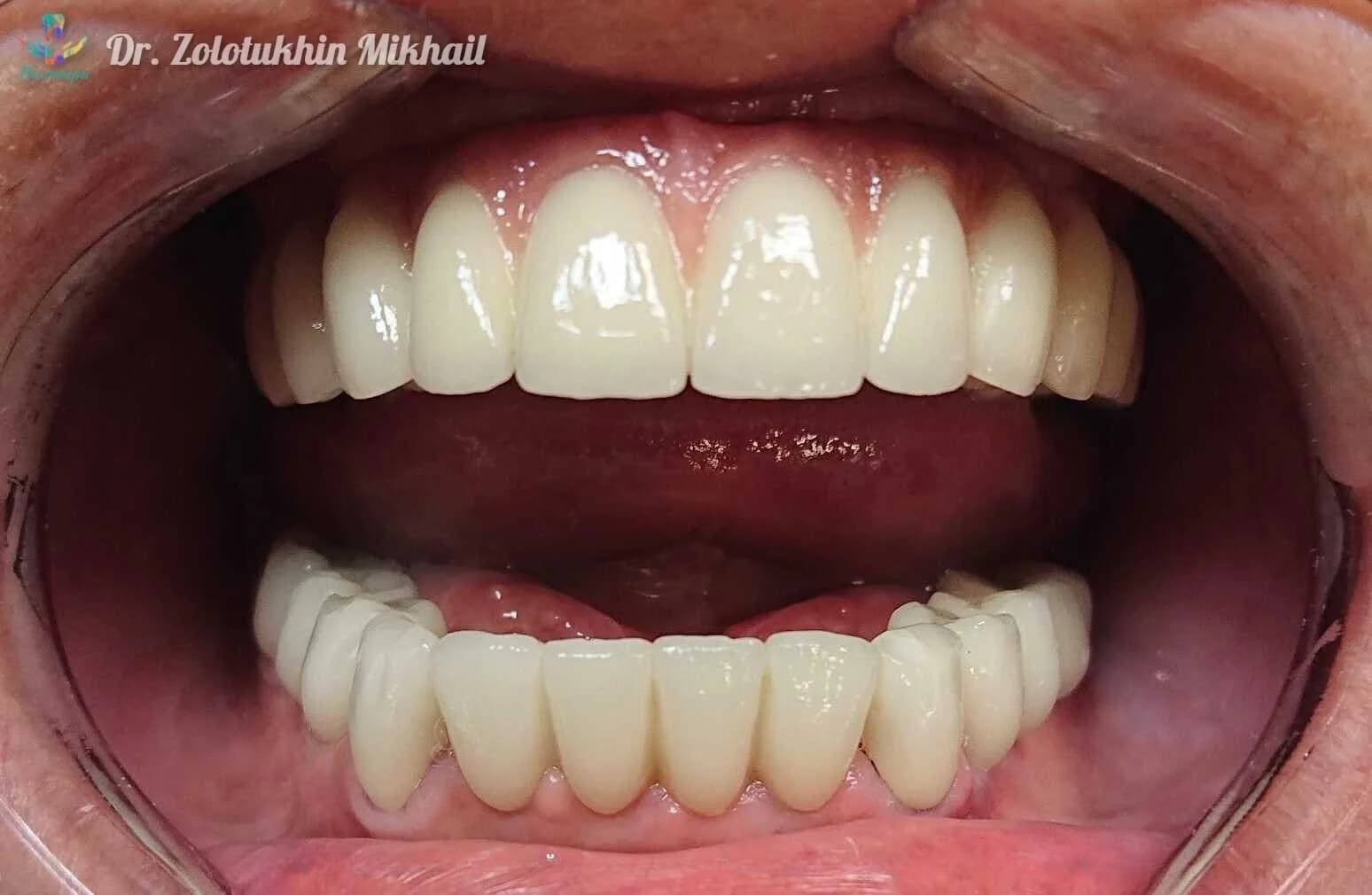 Восстановление на имплантатах при полной адентии