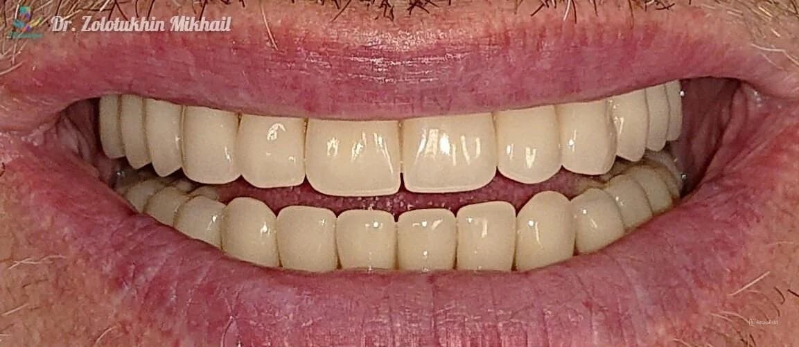 Полные съёмные протезы на обе челюсти