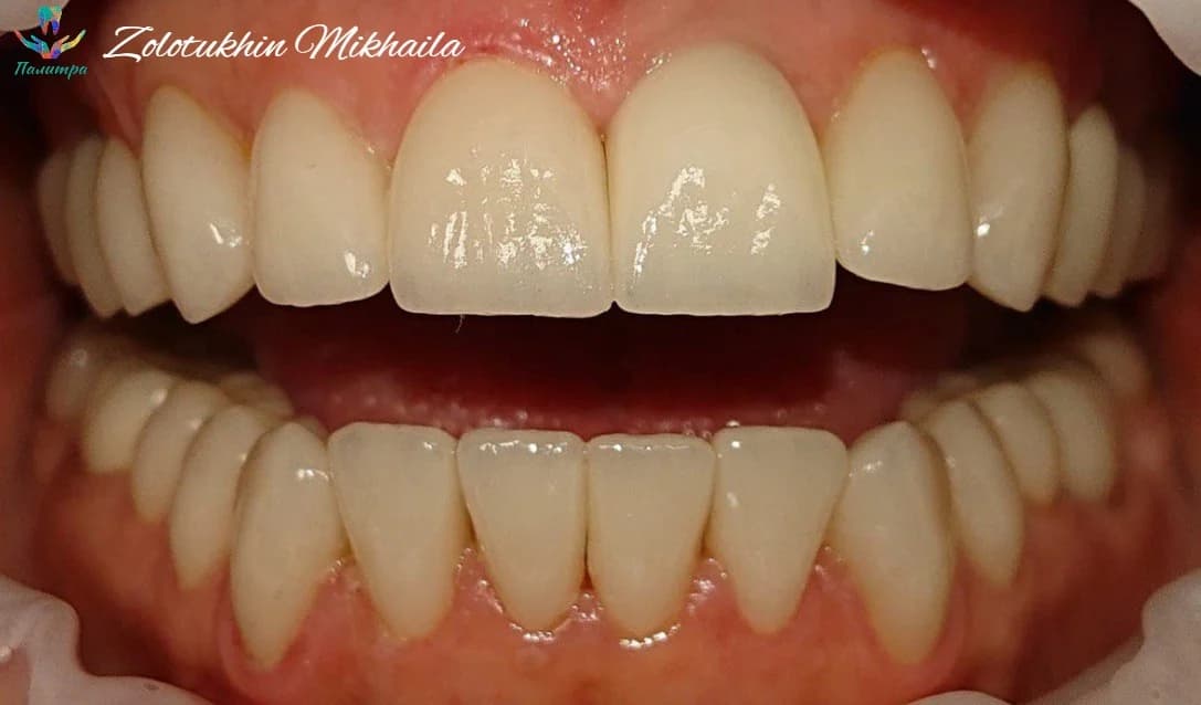 Тотальная реконструкция керамикой и винирами