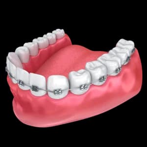 Брекеты металлические