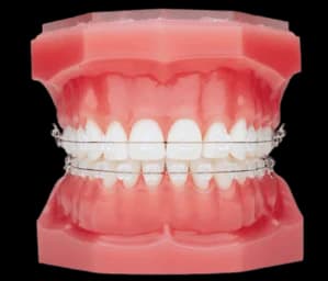 Брекеты керамические