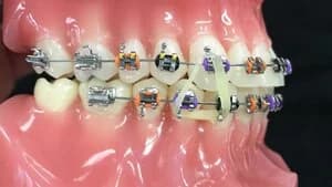 установка брекетов или элайнеров