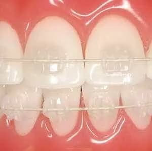 Керамические брекеты на верхних зубах при закрытом рте — эстетичный вариант фиксированной системы