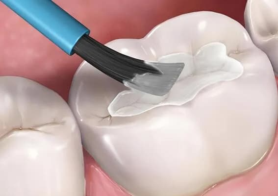 герметизация фиссур