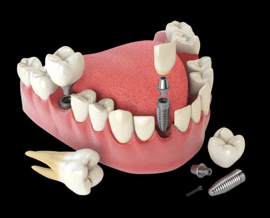 план имплантации после удаления зуба