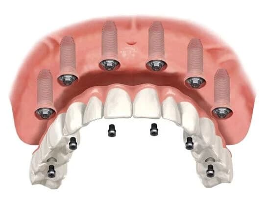 All-on-6 на верхней челюсти