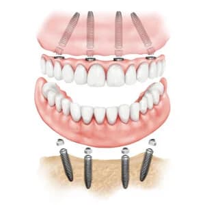 Схема расстановки имплантов и балки протеза на нижней челюсти — пояснение к концепции All-on-4/6