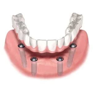 Покрывной протез на имплантах