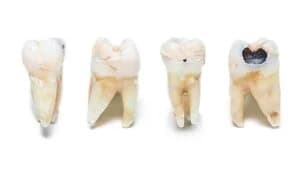 Сильное повреждение зуба