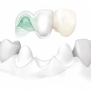 Коронка на зуб из диоксида циркония