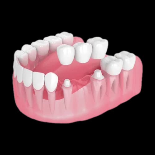 защита зуба коронкой