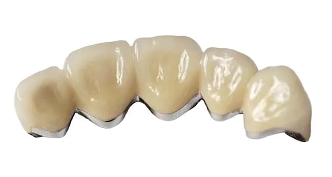 Металлокерамическая коронка