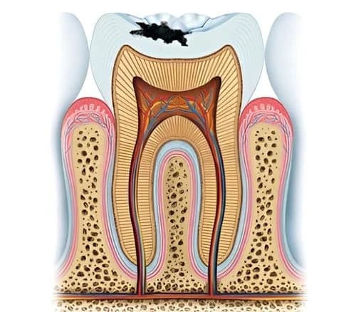 Стоматолог осматривает зубы пациента с подсветкой — иллюстрация к статье о кариесе и профилактике