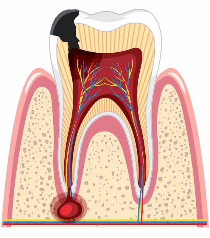 как выглядит периодонтит у корня зуба