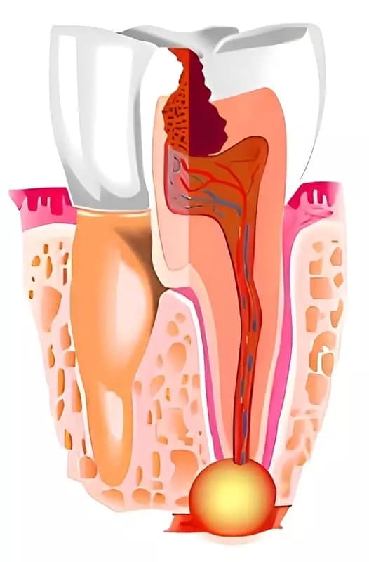 лечение пульпита ребёнку