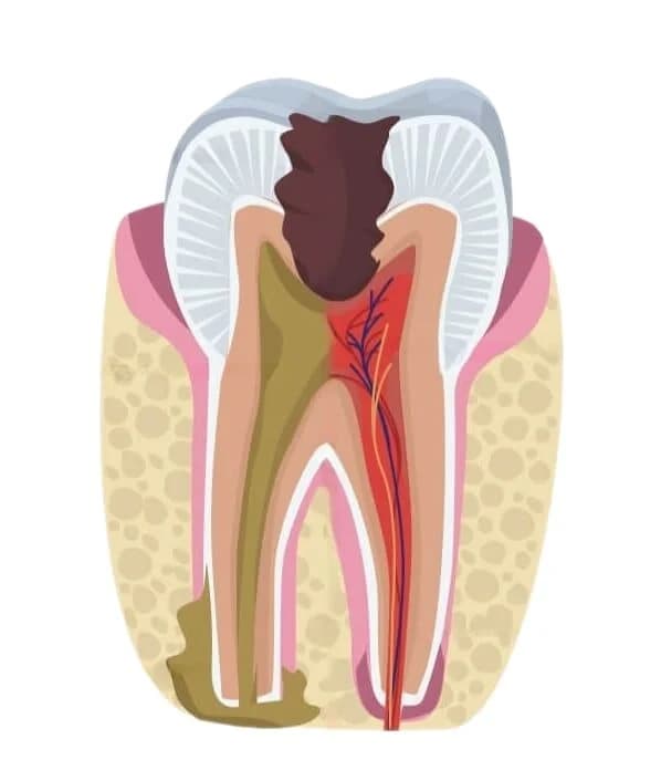 пульпит у ребёнка