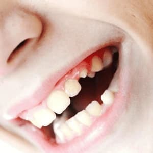 разрушенный зуб