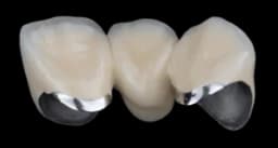 Металлокерамическая коронка