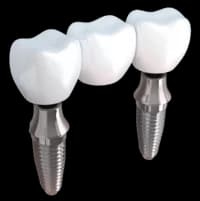 Мост на имплантах