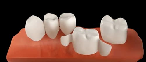 Адгезивный мостовидный протез