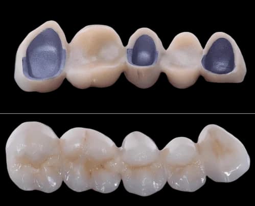 Металлокерамический мост