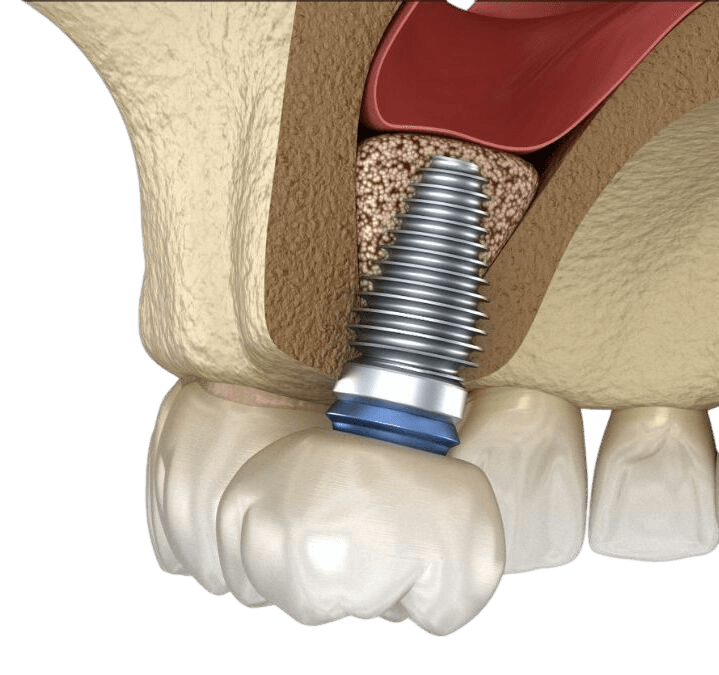 Схематичный разрез верхней челюсти: область гайморовой пазухи и костный гребень — визуализация к теме синус-лифтинга