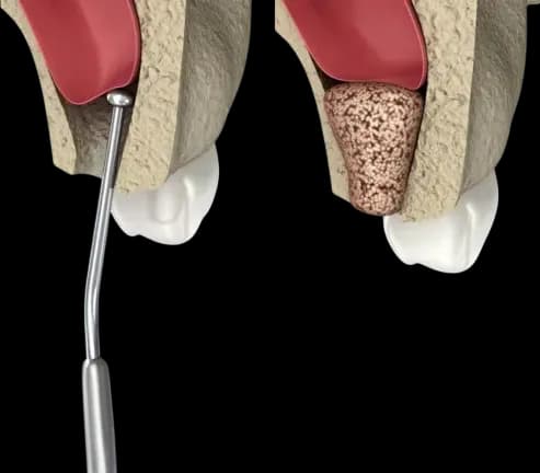 Синус-лифтинг