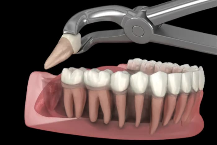 удаление зуба