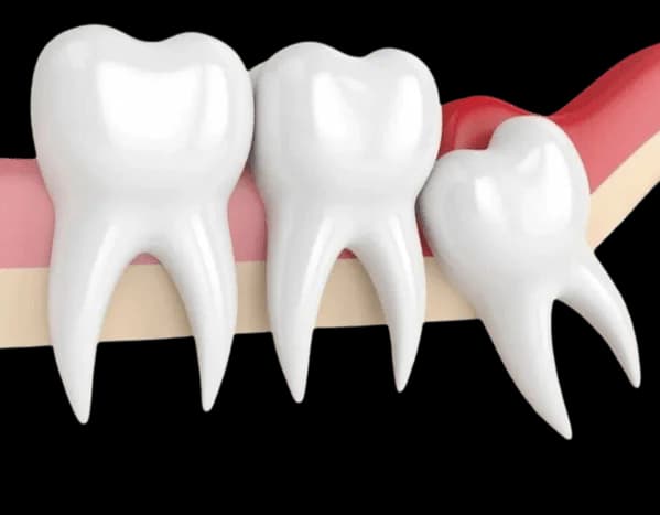 сложное удаление зуба