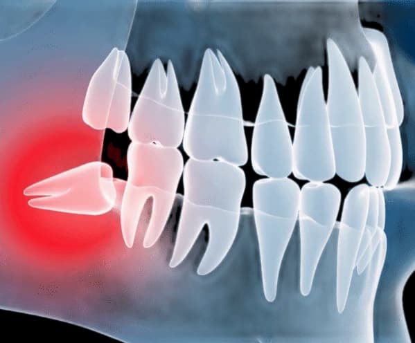 зуб мудрости